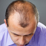 Diagnosis of Hair Loss
